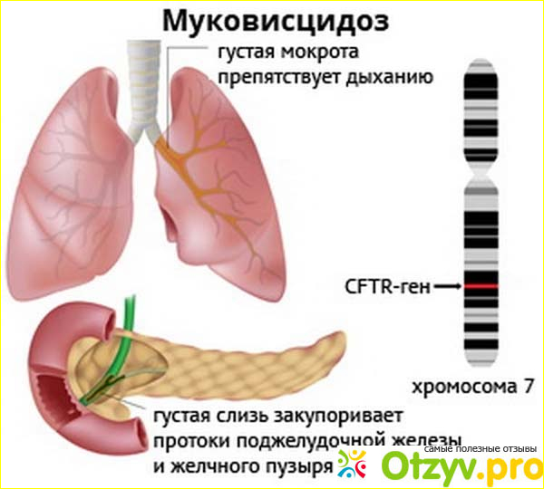 Отзыв о Муковисцидоз - опасное для жизни генетическое заболевание.