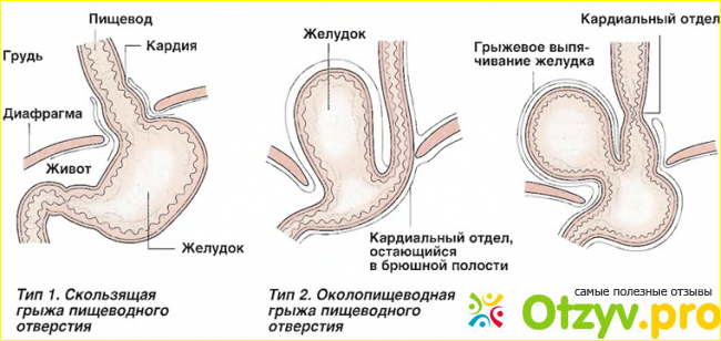 Как лечат грыжу?