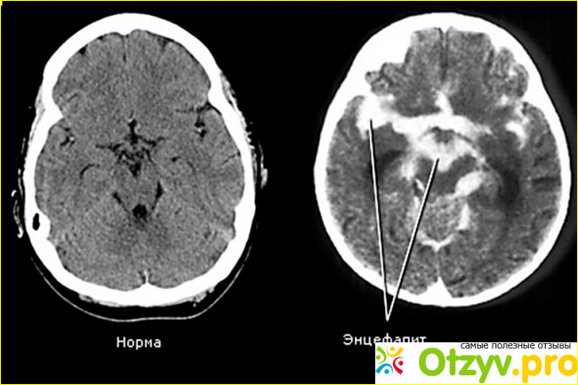 Энцефалит – Патогенез и симптомы фото1