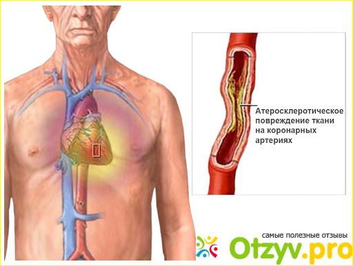 Симптомы стенокардии фото1