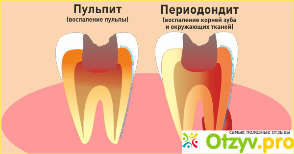 Пульпит зуба - бомба замедленного действия фото1