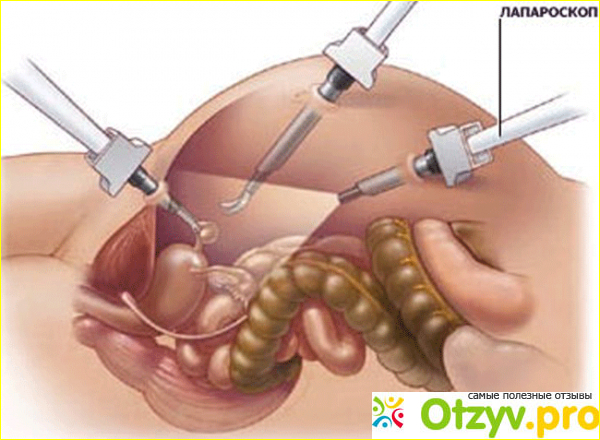 Лапароскопия желчного пузыря назначение процедуры фото1