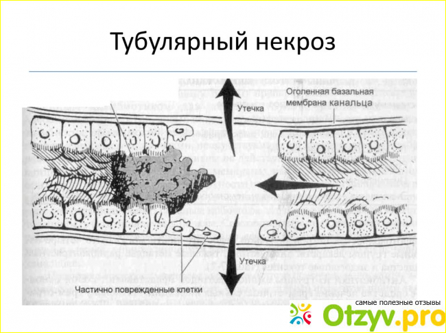 Что такое острый тубулярный некроз фото1