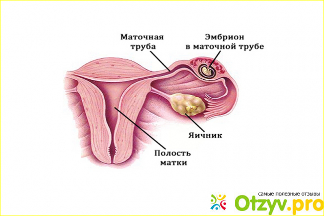 Отзыв о Чем опасна внематочная беременность
