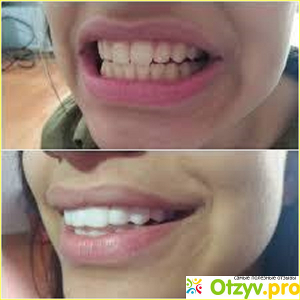 Отзыв о Trusmile veneers реальные отзывы покупателей