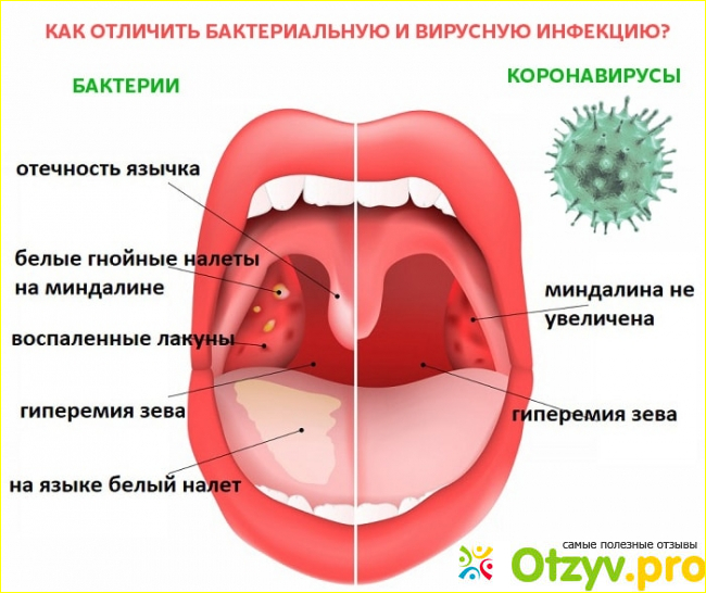 Отличительные особенности коронавирусной инфекции