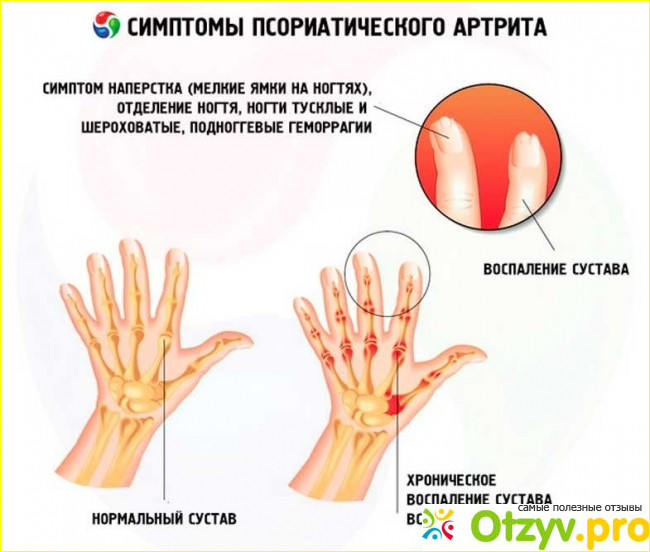 Псориатический артрит клинические рекомендации 2020 фото2