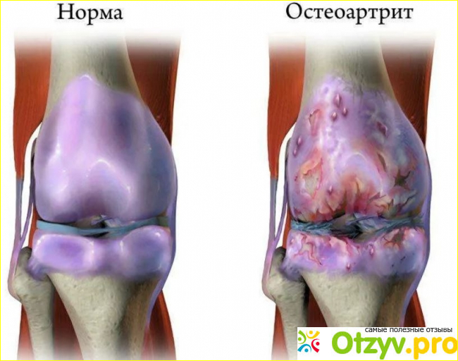 Течение остеоартрита