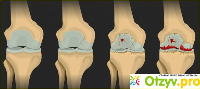 Какие бывают виды остеоартрита?