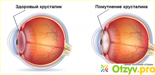 Признаки и симптомы катаракты