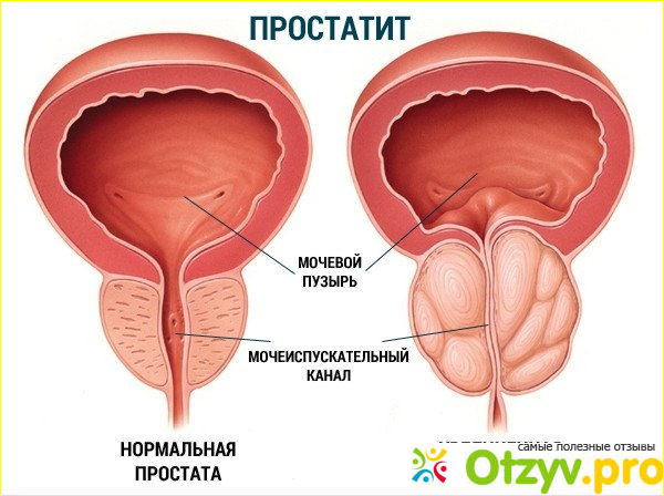 Где купить Уропрост лекарство от простатита?