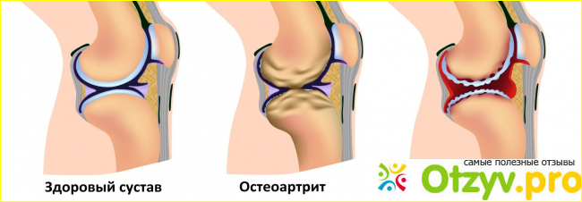 Отзыв о Артроверон отзывы