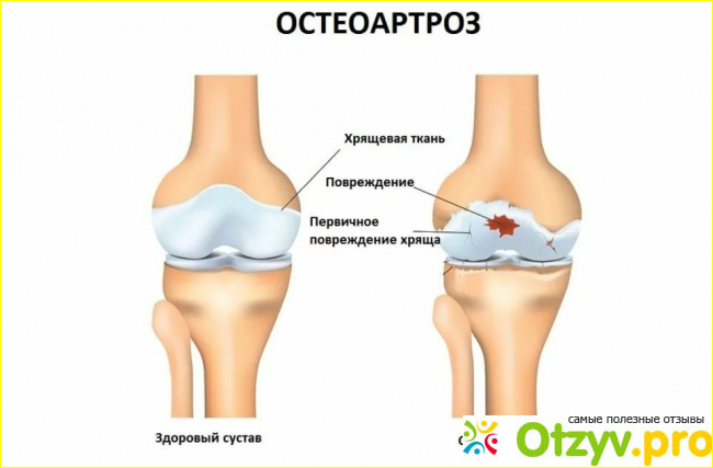 Отзыв о Артродарин