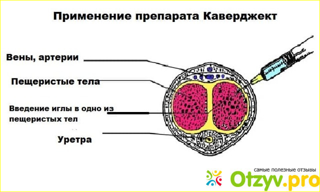 Каверджект купить