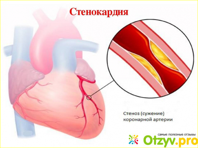 Стенокардия: симптомы и лечение
