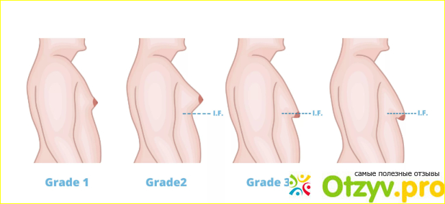 Гинекомастия у мужчин лечение