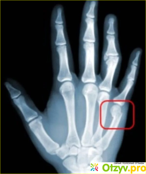 Поврежденный палец — не приговор
