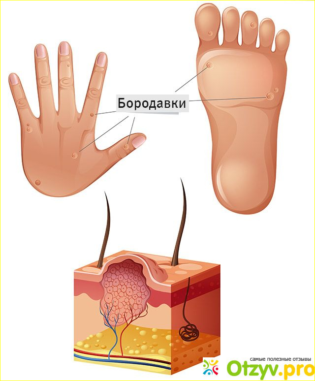 Как убрать папилломы в домашних условиях быстро?