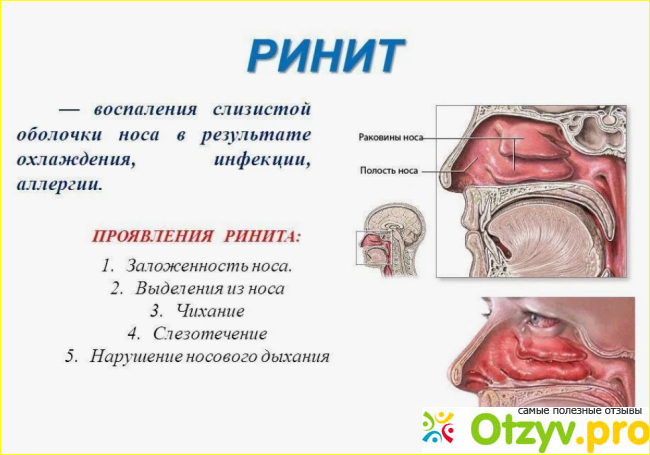 Применения средства «Риностоп» от насморка