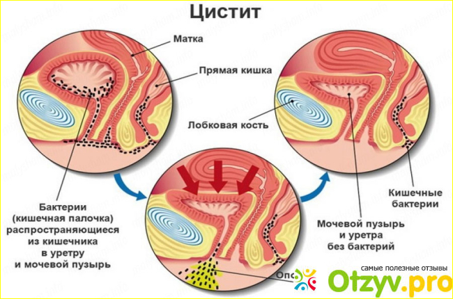 После лечения цистита остались позывы в туалет