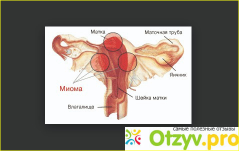 Народные матки. Миома матки народные средства. Миома матки и плодное яйцо. Множественная миома матки народными средствами.