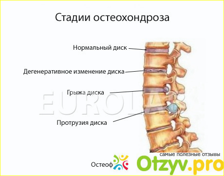 Остеохондроз 3 степени поясничного отдела позвоночника. Полисегментарный остеохондроз шейного отдела. Задние краевые остеофиты тел l2-s1. Остеохондроз 1 2 степени что это. Остеохондроз шейного отдела степени.
