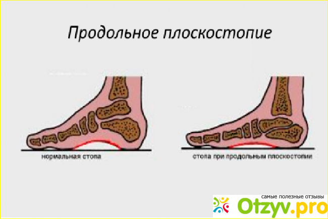 Плоскостопие травматология презентация