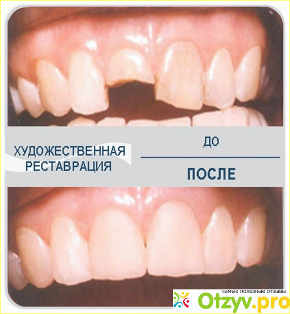 Можно нарастить передний зуб. Наращивание поломанного зуба. Наращивание отломленного зуба. Наращивание разбитого зуба.