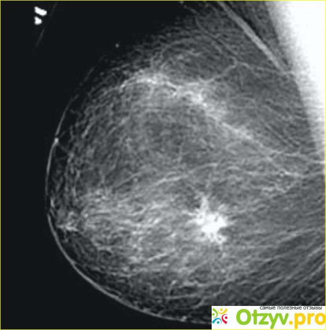 Филлоидная фиброаденома молочной железы узи. Фиброзная ткань на узи молочной железы. Рмж кальцинаты маммограмма. Методика исследования молочных желез. Очаговые тени молочных желез.