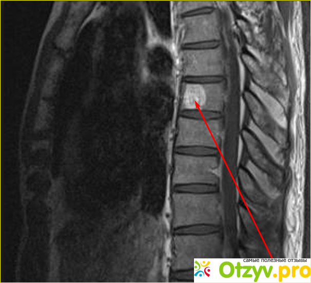 Гемангиома позвоночника может рассосаться. Гемангиома th7 позвонка что это. Гемангиома позвоночника тн11. Гемангиома позвоночника th12 , l1. Гемангиома позвоночника мкб.