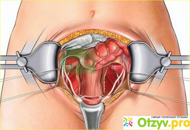 Тотальная матка. Операция удаление матки. Полостная операция на матке.